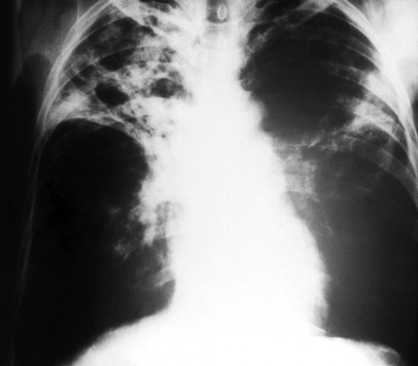 X-ray of lungs with advanced TB